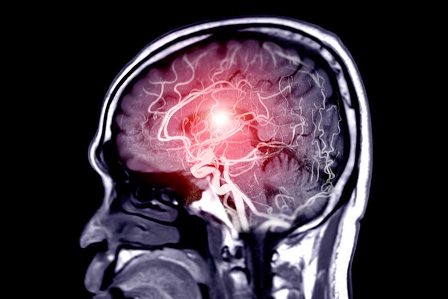 medical image of cerebral artery in the brain